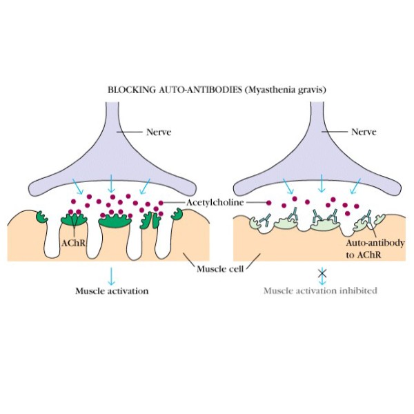 myasthenia-gravis-silicon-beach-medical-center