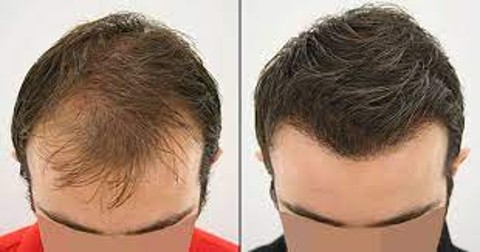 hair transplant